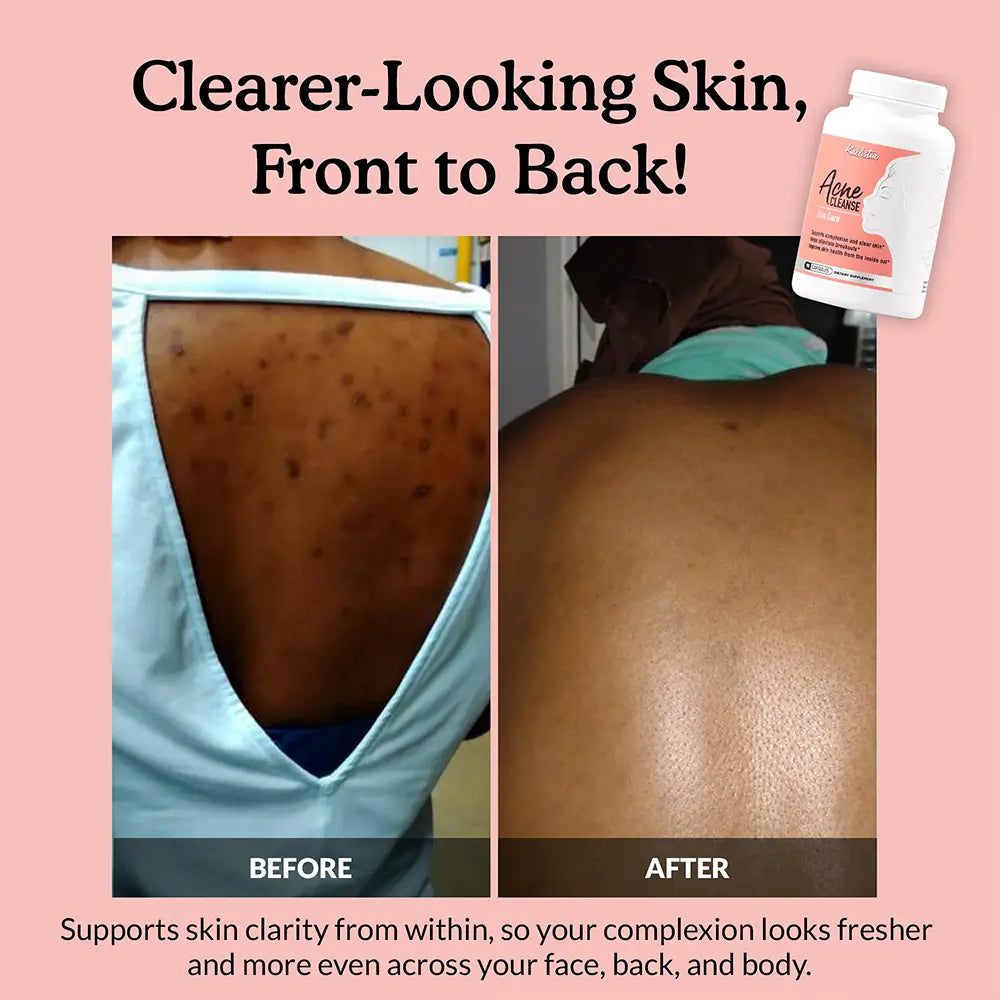 Acne Cleanse Capsules