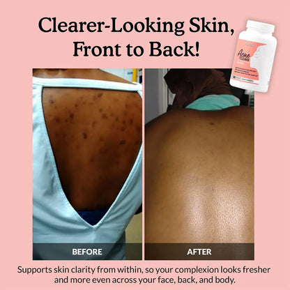 Acne Cleanse Capsules
